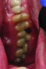 Fig 8. Left and right quadrants showing interocclusal space. Interocclusal space can be a reference for loss of vertical or can be a case of passive eruption.