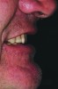 Fig 9. Direct composite was added intraorally to determine incisal edge position.
