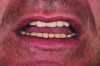 Fig 11. Incisal display in repose.