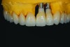 Fig 14. Final ceramics on maxillary arch with implant-retained restoration.