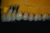 Fig 16. Right and left views of ceramic restorations on the casts.