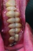 Fig 17. Left and right sagittal views of patient at 2-year follow-up. Interocclusal space was increased by crown lengthening and slight vertical openin