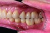 Fig 18. Left and right sagittal views of patient at 2-year follow-up. Interocclusal space was increased by crown lengthening and slight vertical openin