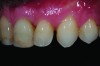 Fig 5. The diastema noted between teeth Nos. 10 and 11.