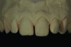 Fig 6. The central incisors were waxed larger and also lengthened with tooth display in mind.
