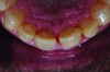 Fig 9. Plenty of natural tooth structure remained, but all 4 maxillary incisors had been endodontically treated.