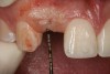 Figure 12 Clinical examination of the bound edentulous space: Measurement of the distal (Fig 10) and mesial (Fig 11) interproximal tissue height using a periodontal probe supplements data obtained from the periapical radiograph. Estimation of the buccal t