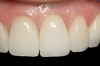 Fig 2. Use of an all-ceramic crown over the abutment to provide excellent esthetics and match adjacent all-ceramic restorations.