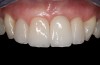 Fig 25. Final restorations 7 months after cementation of the crowns.