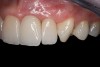 Fig 26. Final restorations 7 months after cementation of the crowns.