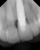 Fig 27. Radiograph of the final restoration demonstrating absence of subgingival cement/bonding agent.