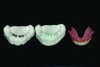 Fig 20. Laboratory simulation of the final implant positions with restorative components in place. The components are waxed over to create space for pick up materials and the result is then duplicated.