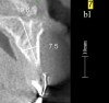 Figure 18 Volumetric characterization of the residual alveolar ridge using CBCT: Fig 17—The coronal section of the maxilla reveals the cortical structure of the alveolar ridge associated with the missing right central incisor at the mid-root level. The bu