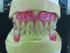 Fig 10. The denture base acrylic-resin and teeth are passible, although a multitude of problems exist with these RPDs. Note the high height of contour on the canine and pre-molars due to the undesirable undercut. The height of contour and the guide planes should have been lowered at the mounted study cast and case planning process, and then the teeth should have been modified before final impressions.