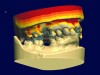 Fig 19. Digital RPD technology is rapidly improving with a growing demand in prosthetic dentistry. There is a place for printed partial frameworks using a Selective Laser Melting (SLM) process. This process will definitely eliminate the processing variables that we now know. These digitally designed and waxed RPDs illustrate the advantages of a digital design workflow process.