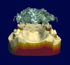 Fig 20. Digital RPD technology is rapidly improving with a growing demand in prosthetic dentistry. There is a place for printed partial frameworks using a Selective Laser Melting (SLM) process. This process will definitely eliminate the processing variables that we now know. These digitally designed and waxed RPDs illustrate the advantages of a digital design workflow process.