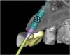 Figure 19 Volumetric characterization of the residual alveolar ridge using CBCT: Fig 17—The coronal section of the maxilla reveals the cortical structure of the alveolar ridge associated with the missing right central incisor at the mid-root level. The bu
