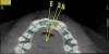 Figure 17 Volumetric characterization of the residual alveolar ridge using CBCT: Fig 17—The coronal section of the maxilla reveals the cortical structure of the alveolar ridge associated with the missing right central incisor at the mid-root level. The bu