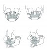 Fig 1. The face collapses inward when the bone and teeth are lost.