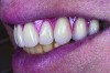 Fig 11. The teeth within the lip frame on the trial base while the patient smiles broadly.