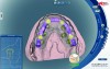 Fig 15. A scan of the prototype prosthesis, superimposed over the scan of the master cast in the planning stages of the definitive prosthetic, shows the space available.