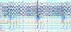 Fig 3. PSG recording during sleep illustrating two apneic events (absence of PTAF 2 signal) followed by arousals with intense efforts to breathe. Note that blood oxygen levels (see OSAT channel) reach their minimum 20-25 seconds after blockage of airflow. Format as in Figure 2.