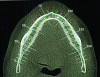 Fig 3. Pre-treatment CBCT, selected occlusal image