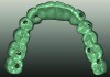 Fig 9. Virtual design of mandibular prototype and definitive restoration, occlusal view (Fig 9) and intaglio view (Fig 10).