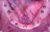 Fig 14. Intraoral occlusal views of maxillary (Fig 13) and mandibular (Fig 14) implant abutments.