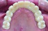 Fig 18. Intraoral occlusal views of maxillary (Fig 18) and mandibular (Fig 19) zirconia restorations at 1.5 years.