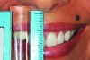 Fig 5. Central incisor display measured during a full smile.