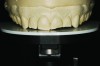 Fig 9. Analysis of the mounted preoperative study models reveals uneven incisal edges.