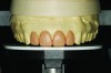 Fig 10. After the selection of the mesio-incisal edge of tooth No. 8 as the correct incisal position, teeth Nos. 7 through 10 are waxed to the platform.