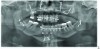 Fig 14. Postsurgical panographic radiograph showing surgical osteotomies and hardware stabilizing the maxilla, mandible, and chin in their new positions.