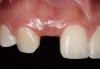 Figure 21 Gingival zenith planning: The location of the gingival zenith for this missing lateral incisor is not fully evident during initial clinical evaluation (Fig 21). Subsequent diagnostic waxing reveals the position of the planned gingival zenith (Fi