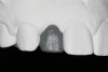 Figure 22 Gingival zenith planning: The location of the gingival zenith for this missing lateral incisor is not fully evident during initial clinical evaluation (Fig 21). Subsequent diagnostic waxing reveals the position of the planned gingival zenith (Fi
