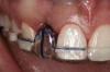 Figure 24 Gingival zenith planning: The location of the gingival zenith for this missing lateral incisor is not fully evident during initial clinical evaluation (Fig 21). Subsequent diagnostic waxing reveals the position of the planned gingival zenith (Fi