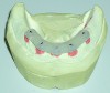 Fig 9. The custom abutments on the soft tissue model with the mounting jig in place.