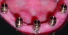 Fig 13. The sealed abutments in the mouth with their retention cap attachments ready to be cold cured into the denture in place.