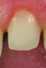 Fig 3. Close-up of the Class I veneer preparation highlights the bur marks and finish line created to assist the ceramist. Note that the finish line is subgingival due to the cervical contour change required to close diastemas on the mesial and distal.