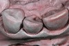 Fig 12. Occlusal view of the conservative Class III veneer preparation design of the same tooth on the die model.