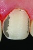 Fig 13. Photograph of the Class III veneer preparation design demonstrating dentin exposure of approximately 20%, falling within the 20% to 50% range for remaining dentin. Note that more than 70% enamel periphery and 50% to 80% enamel remain, which is a crucial consideration criteria for this classification design.
