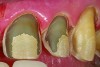 Fig 16. Close-up of an all-ceramic restoration preparation design demonstrating dentin exposure of more than 50%, less than 50% enamel remaining for bonding, and margins with 30% enamel periphery.