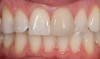 Figure 2  Anterior porcelain veneer restoration.