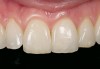 Figure 3  Anterior porcelain veneer restoration.