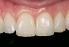 Figure 3  Anterior porcelain veneer restoration.