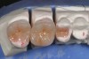 Figure 7  Pressed ceramic restorations.