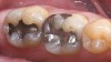 Figure 10  IPS e.max restorations replacing existing amalgams.