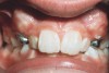 Figure 7  This patient had severe crowded with completely blocked-out canines. Premolar extraction appears to be inevitable.