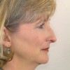 Figure 15  Her profile was retrusive with slightly inadequate lip projection, a low nasal tip, and a nasal dorsal hump.